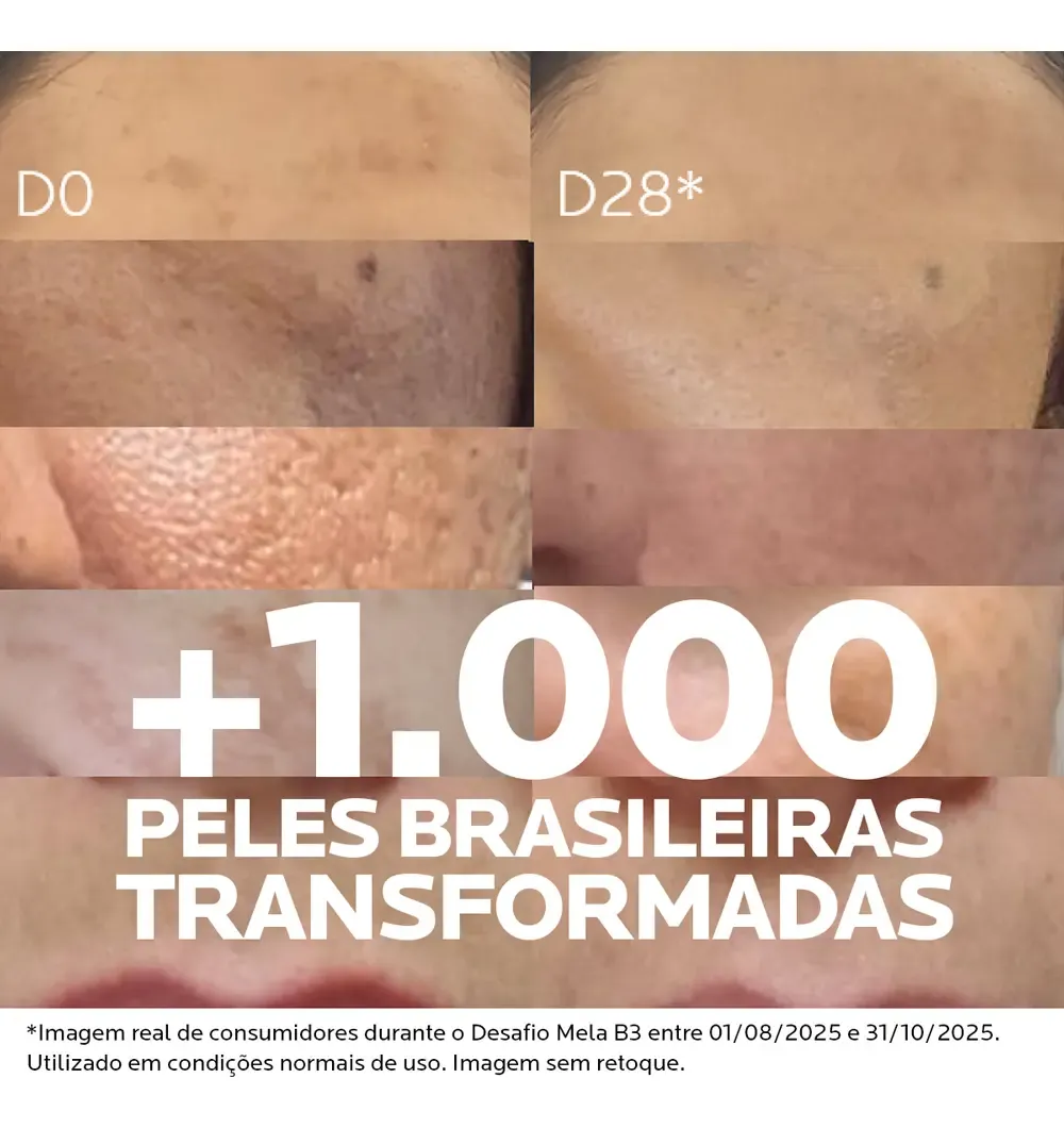 Resultados reais do tratamento de melasma com Mela B3 após 28 dias.