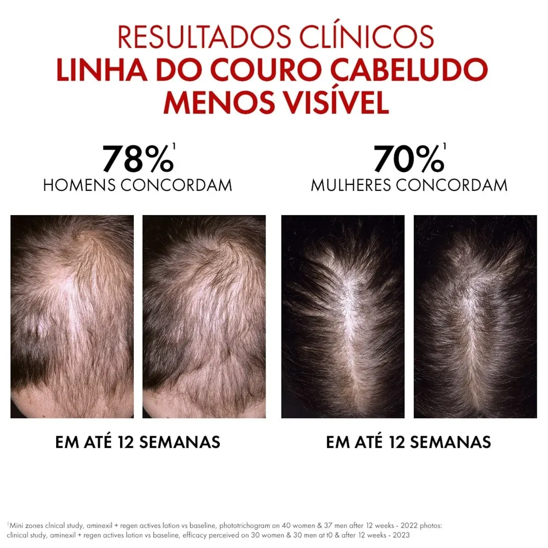 Antes e depois do tratamento com Dercos R.E.G.E.N Booster: resultados visíveis.